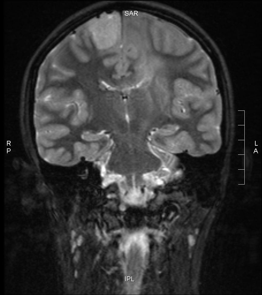 Sadie's initial MRI