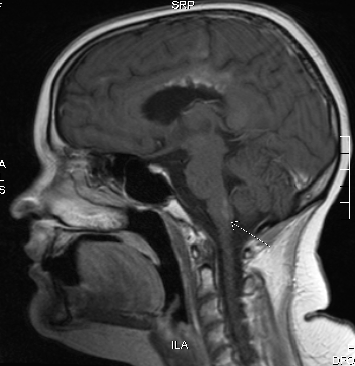 Sadie's fourth post-treatment MRI